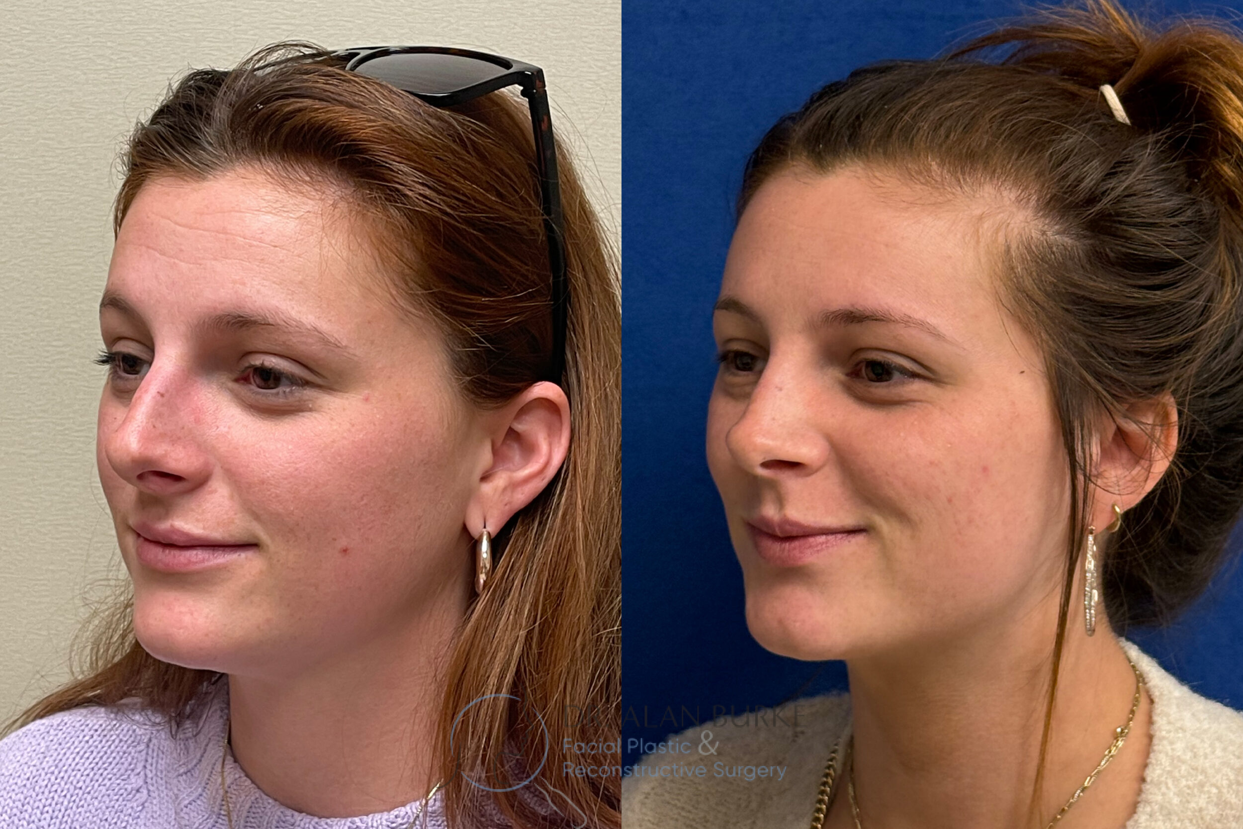 Before and After Image: Rhinoplasty - left-front-oblique