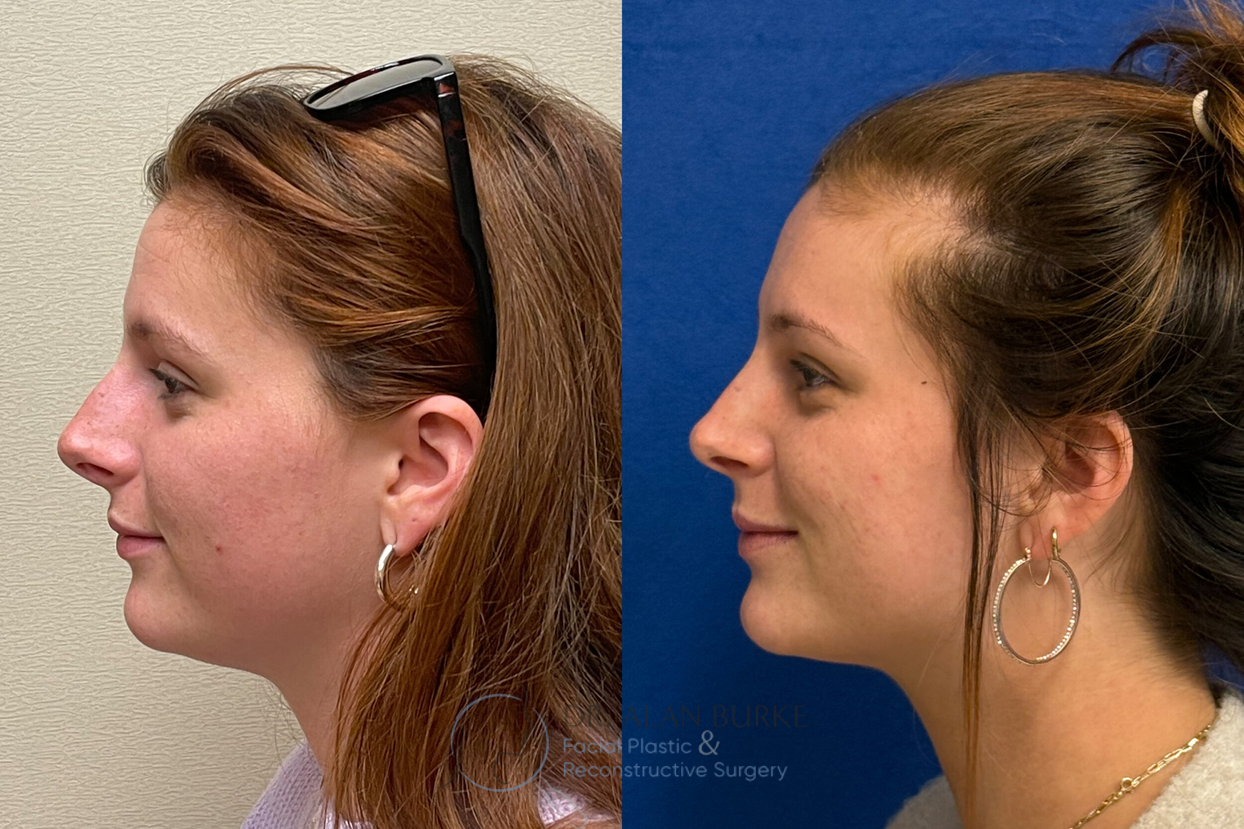 Before and After Image: Rhinoplasty - left-side