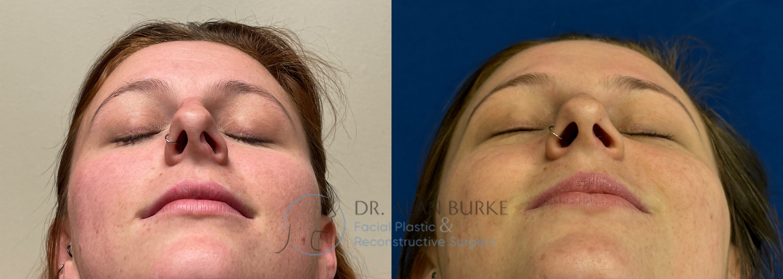 Before and After Image: Rhinoplasty - front