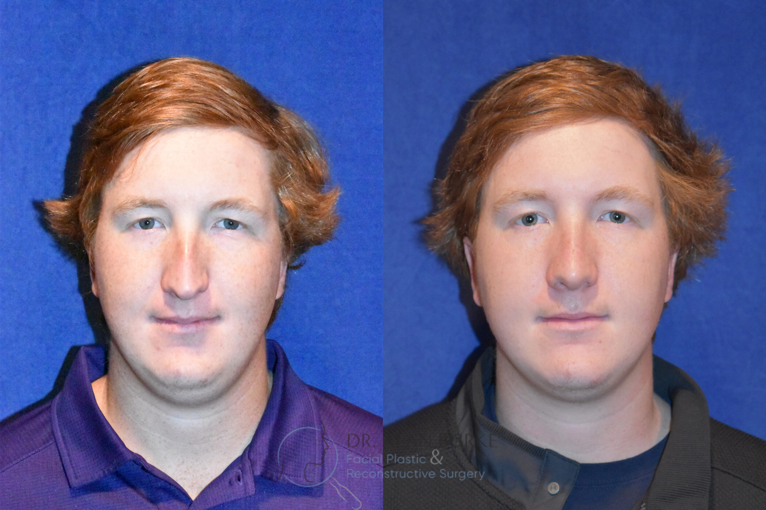 Before and After Image: Rhinoplasty - front