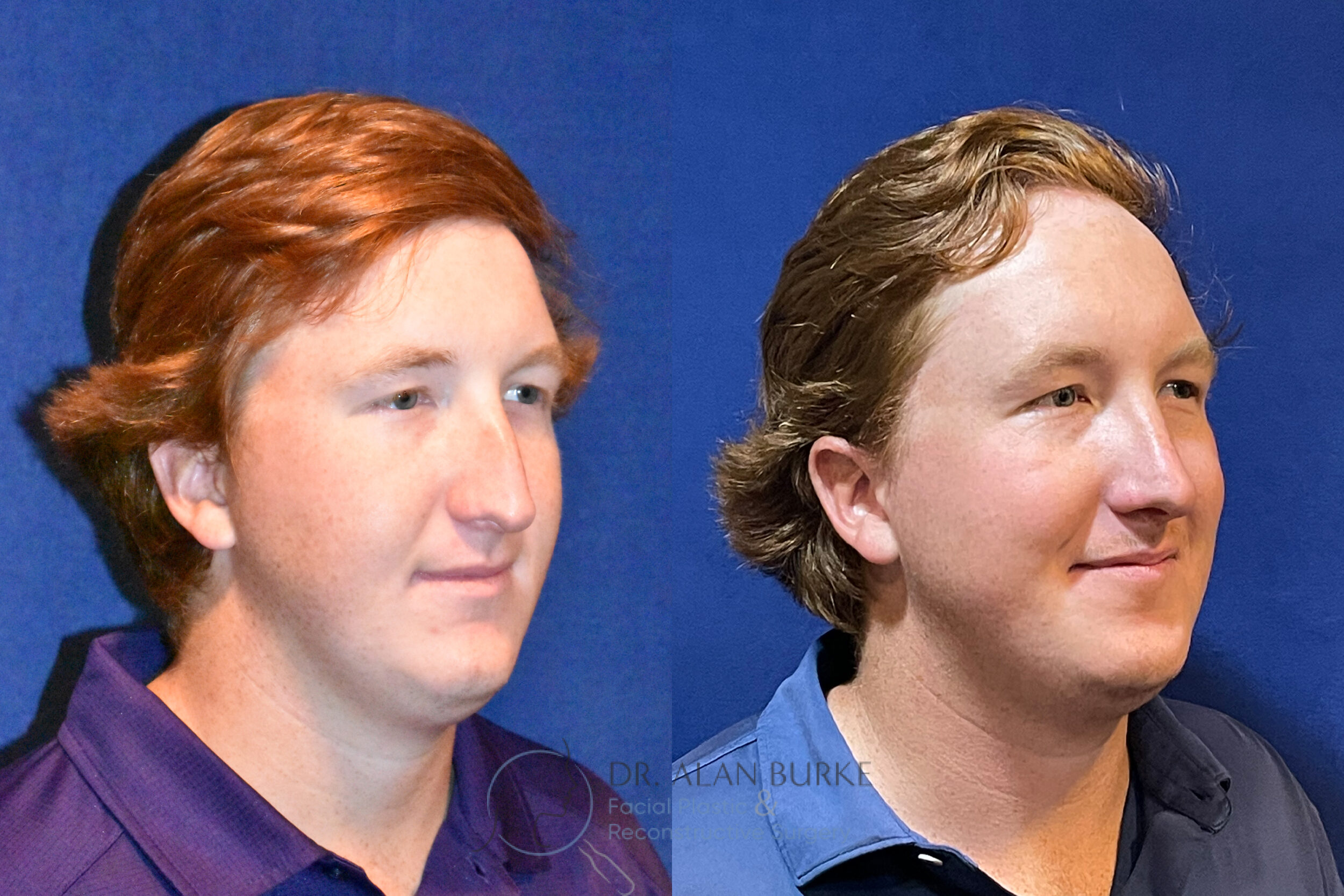Before and After Image: Rhinoplasty - right-front-oblique
