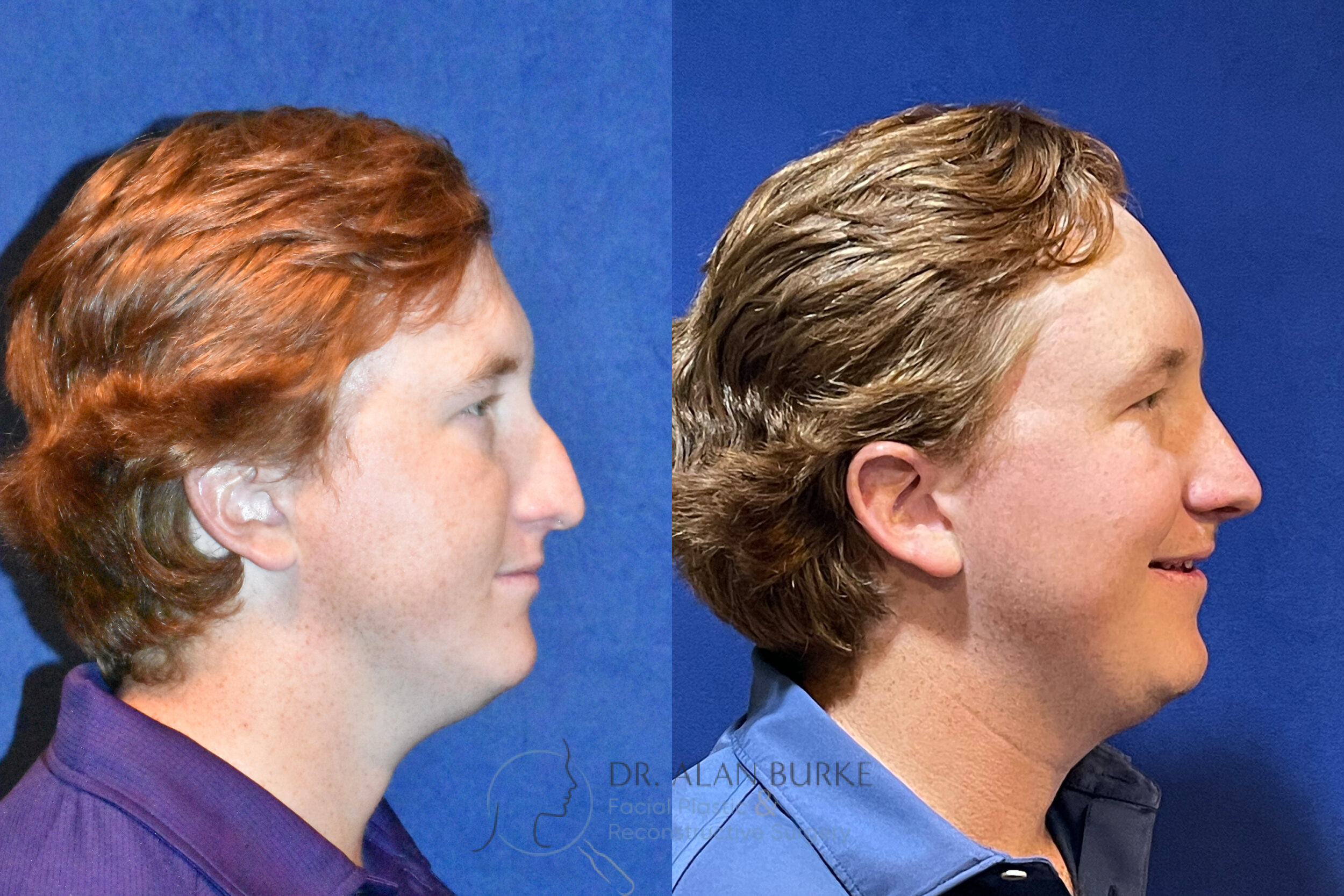 Before and After Image: Rhinoplasty - right-side