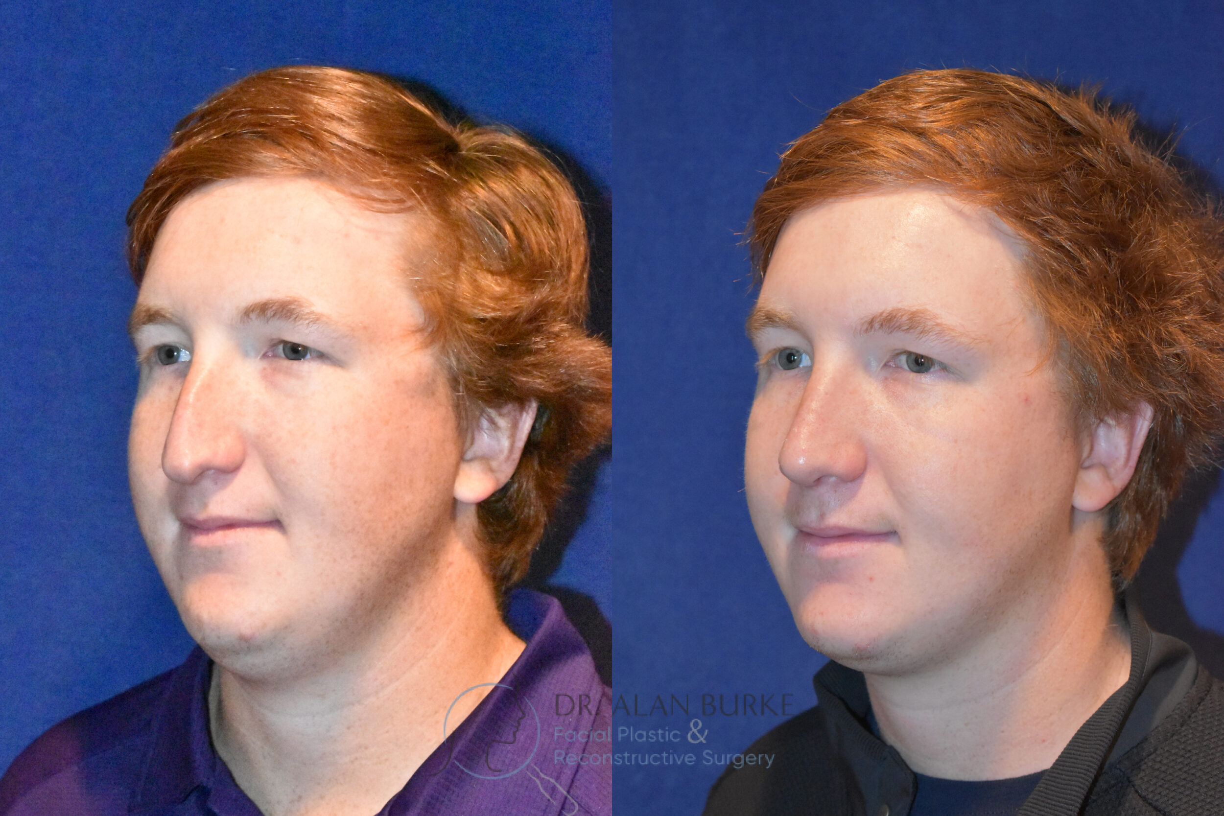 Before and After Image: Rhinoplasty - left-front-oblique