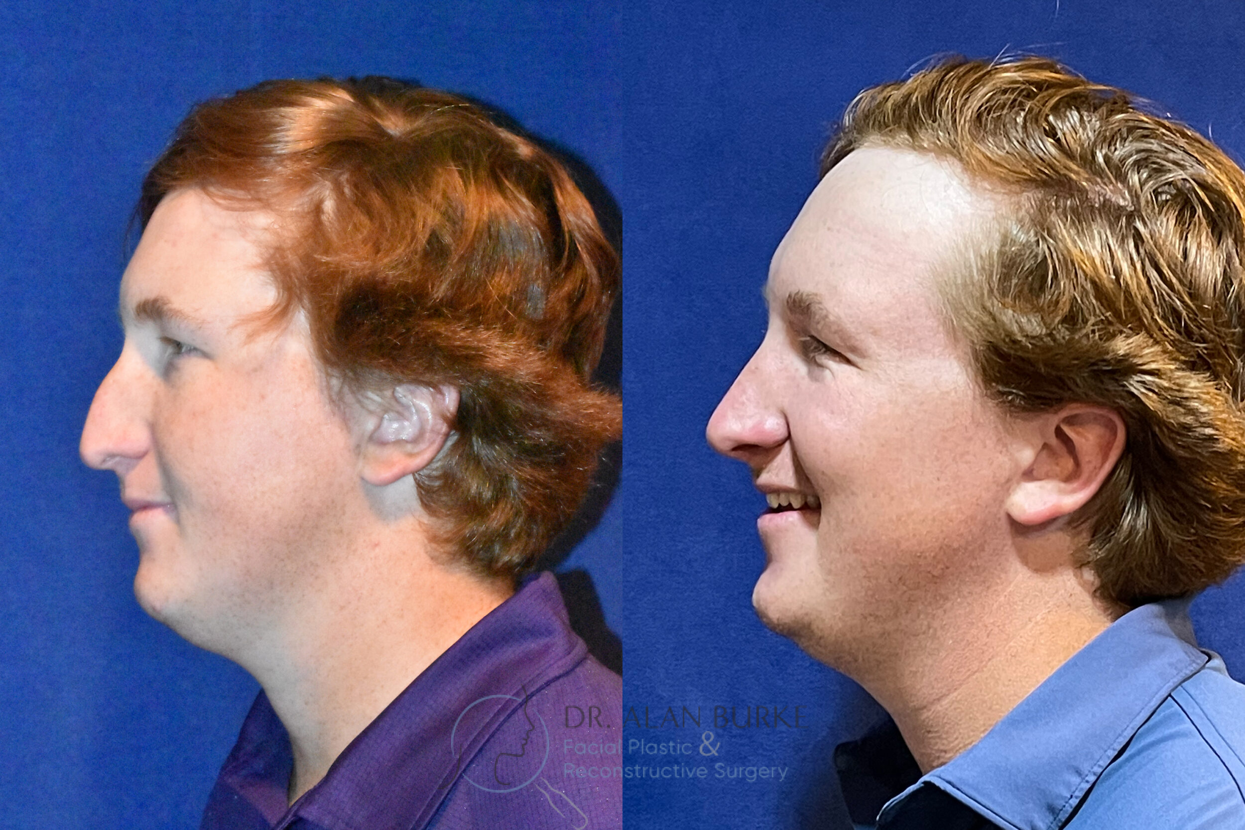 Before and After Image: Rhinoplasty - left-side