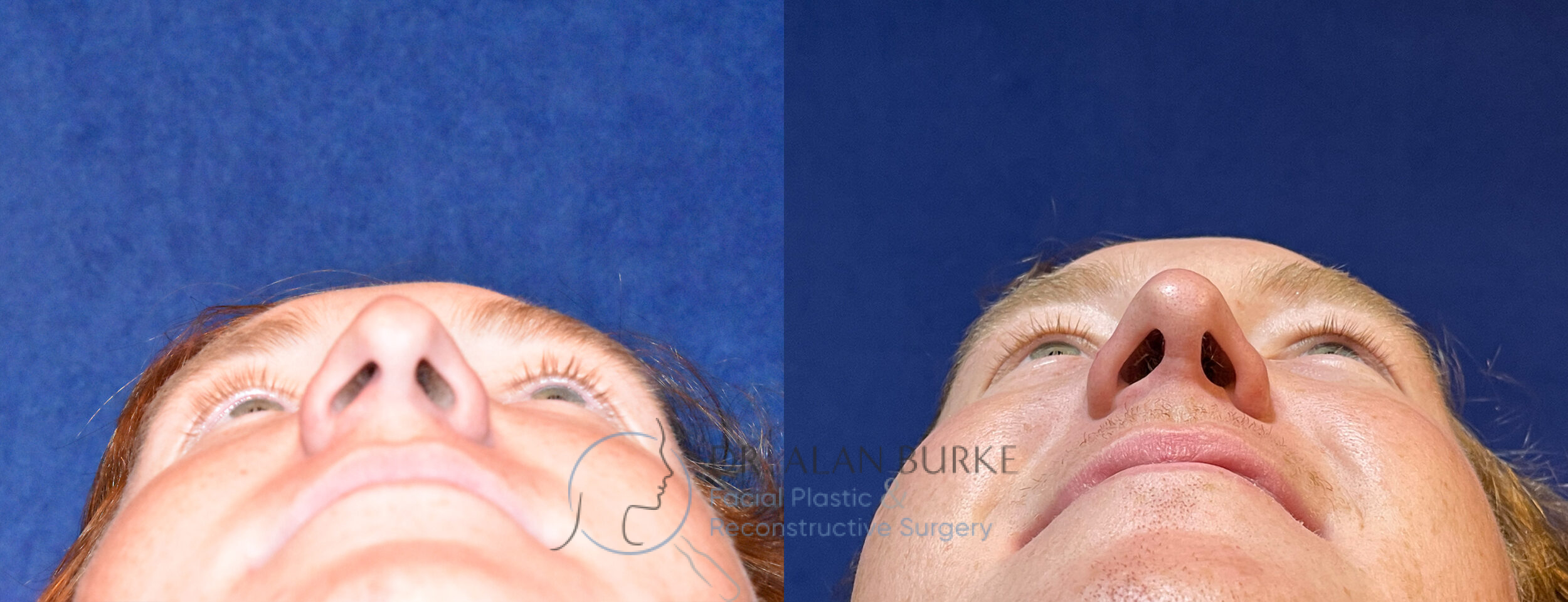Before and After Image: Rhinoplasty - front