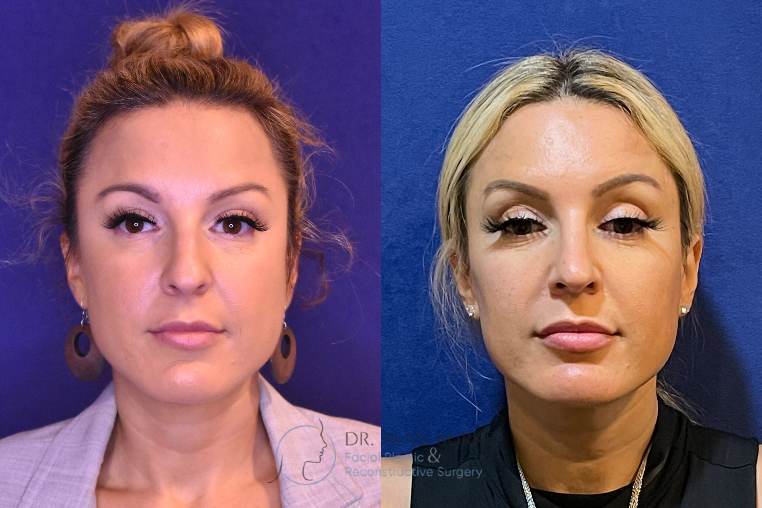 Before and After Image: Rhinoplasty - front