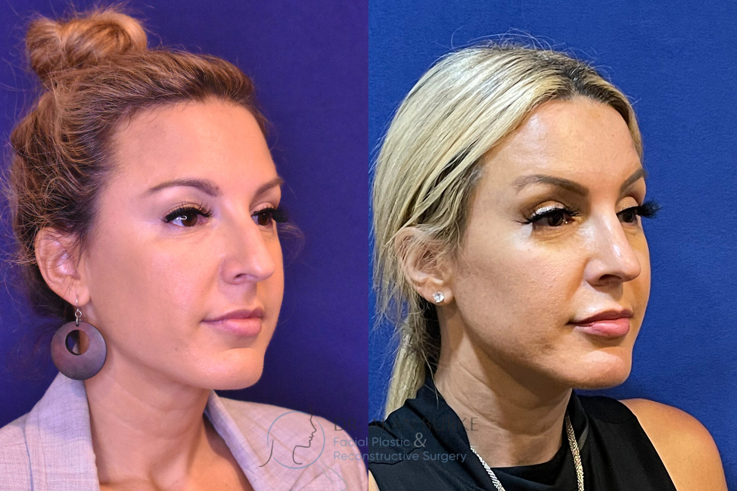 Before and After Image: Rhinoplasty - right-front-oblique