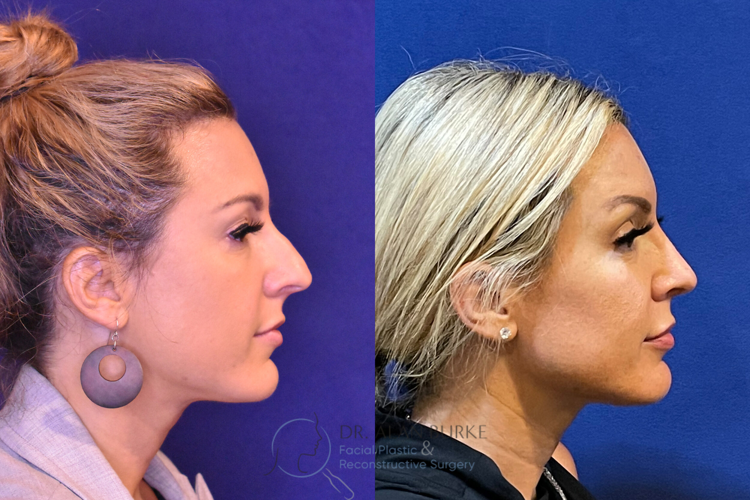 Before and After Image: Rhinoplasty - right-side