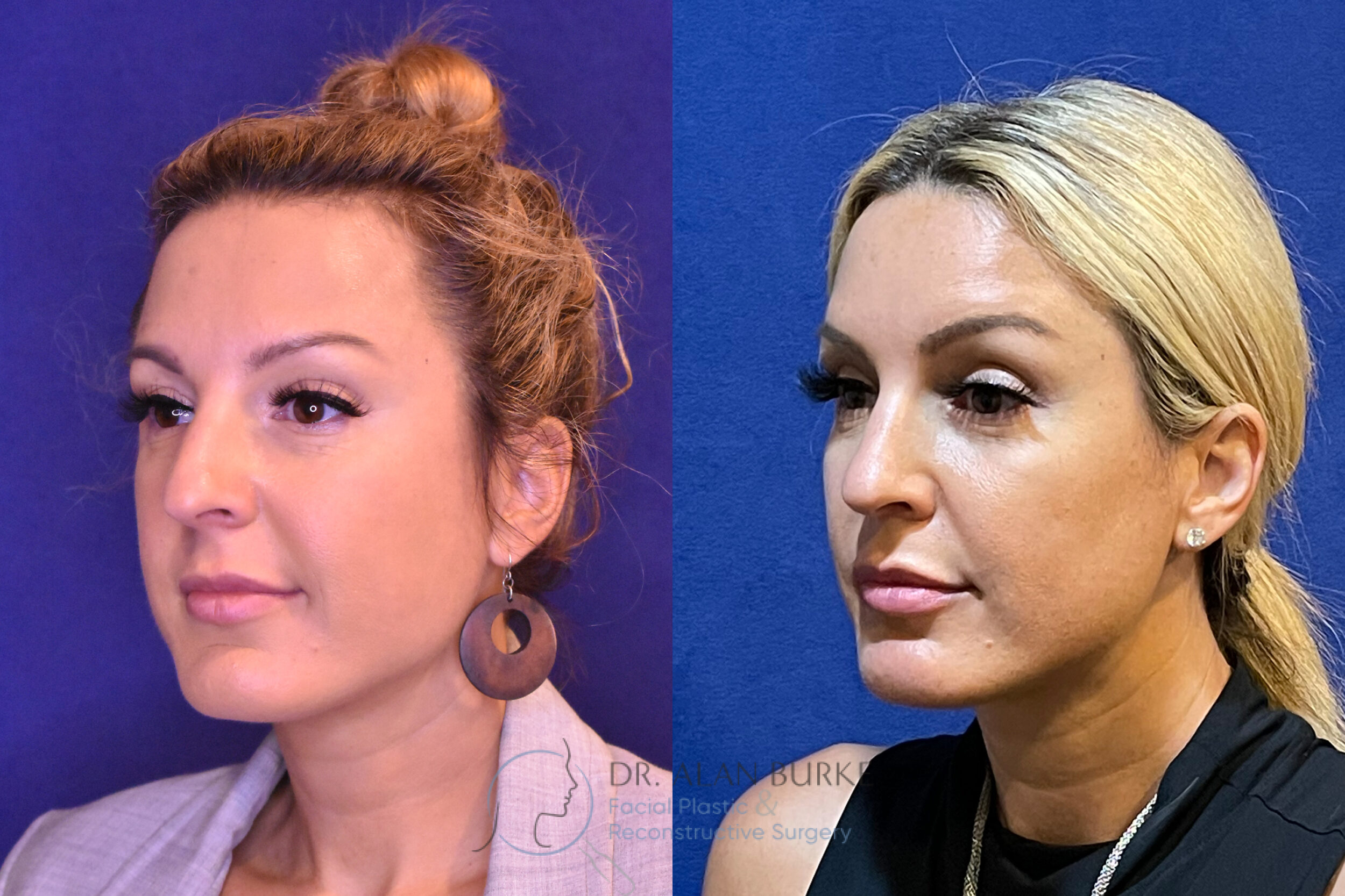 Before and After Image: Rhinoplasty - left-front-oblique