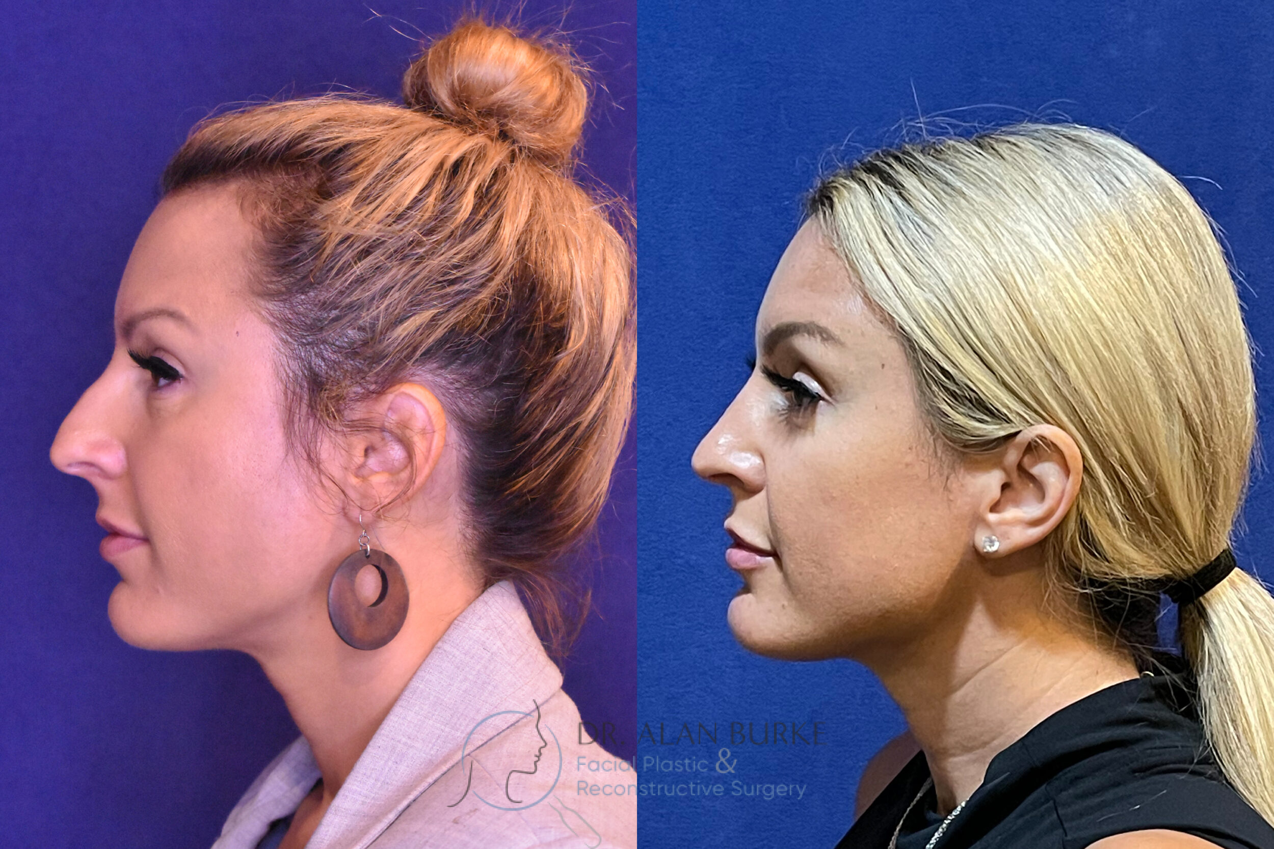 Before and After Image: Rhinoplasty - left-side