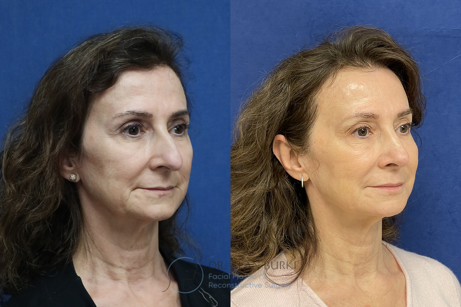 Before and After Image: Rhinoplasty - right-front-oblique