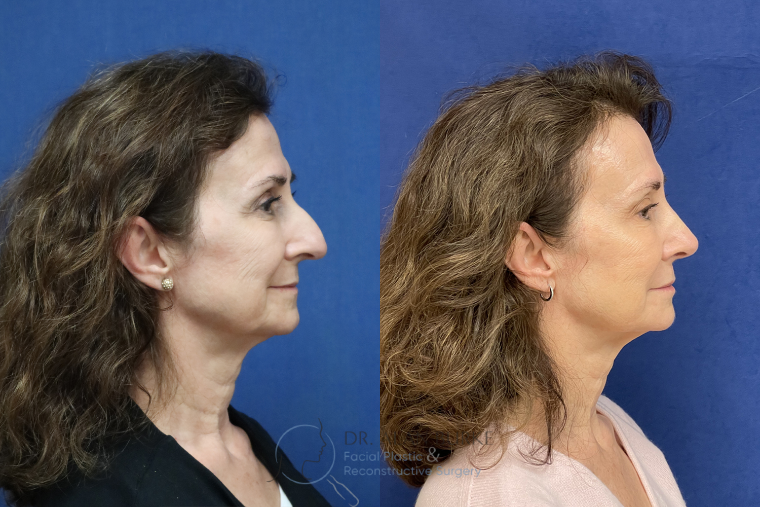 Before and After Image: Rhinoplasty - right-side