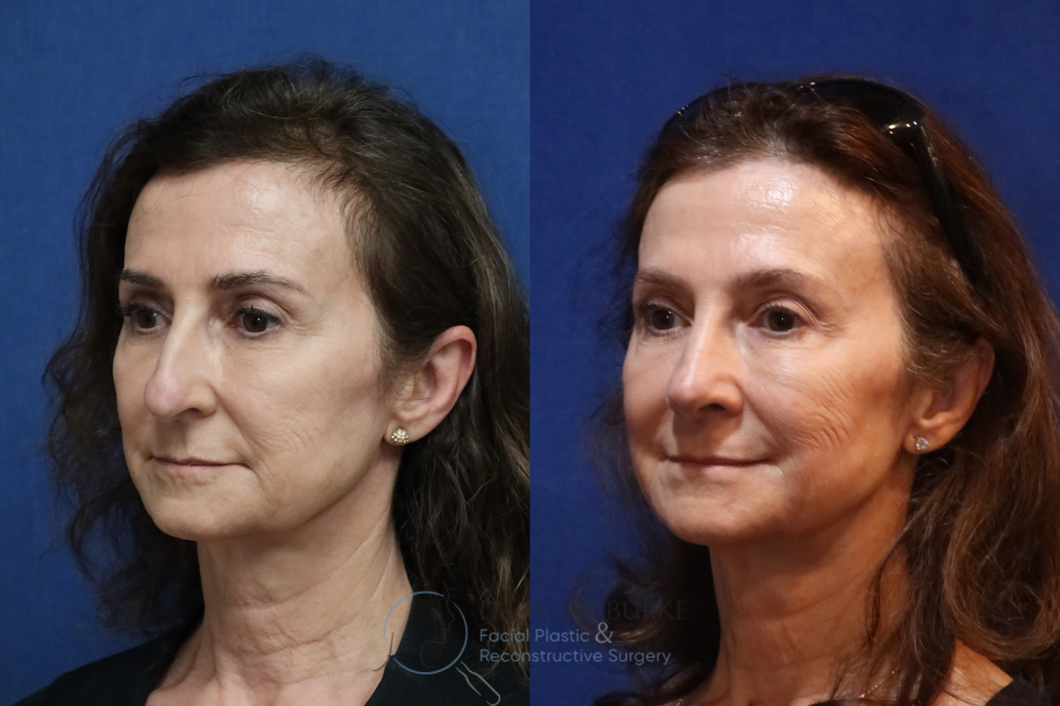 Before and After Image: Rhinoplasty - left-front-oblique