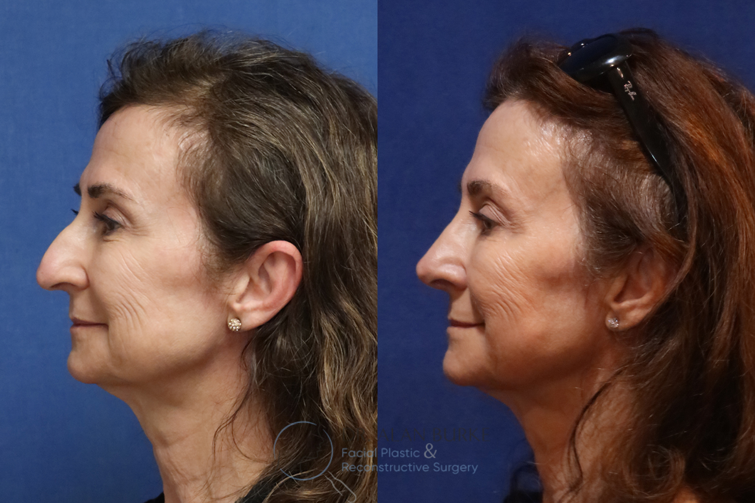 Before and After Image: Rhinoplasty - left-side