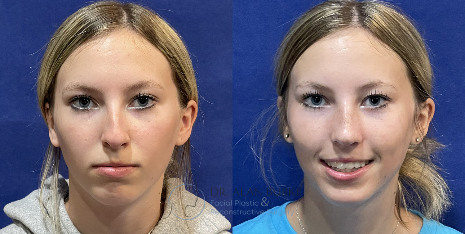 Before and After Image: Rhinoplasty - front