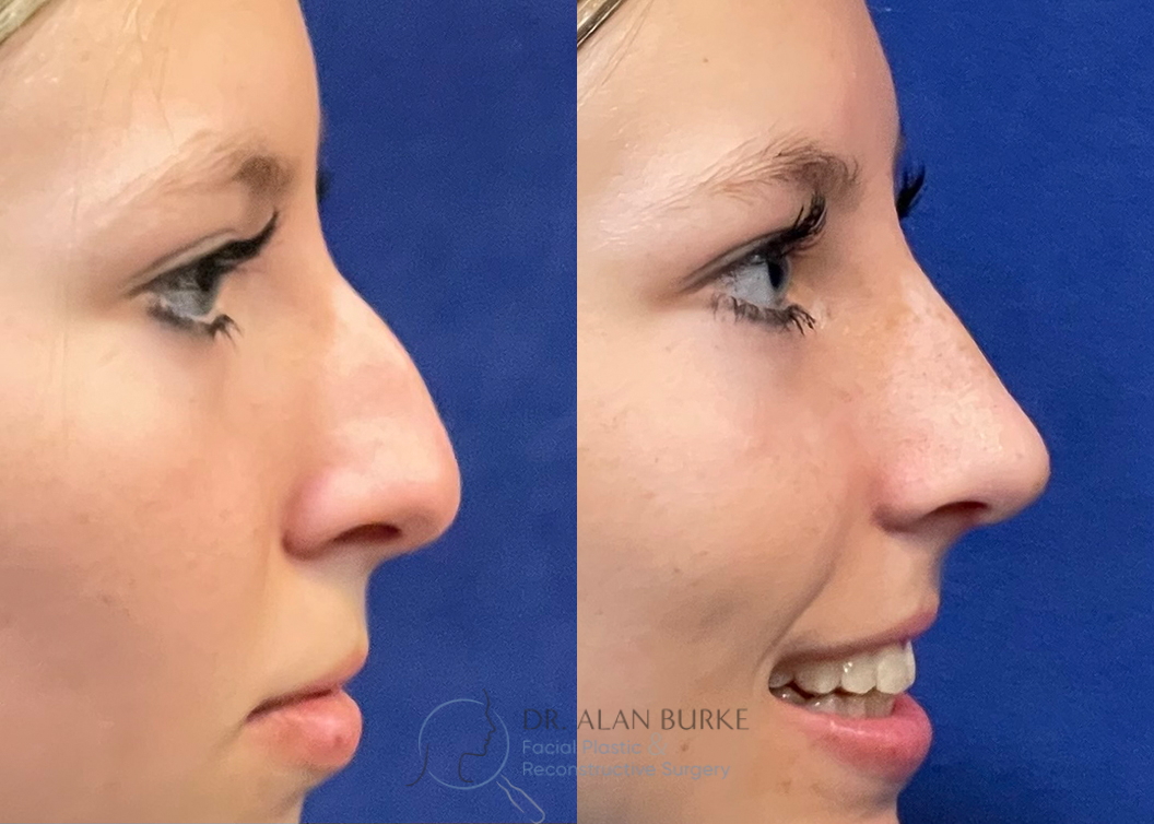 Before and After Image: Rhinoplasty - right-side
