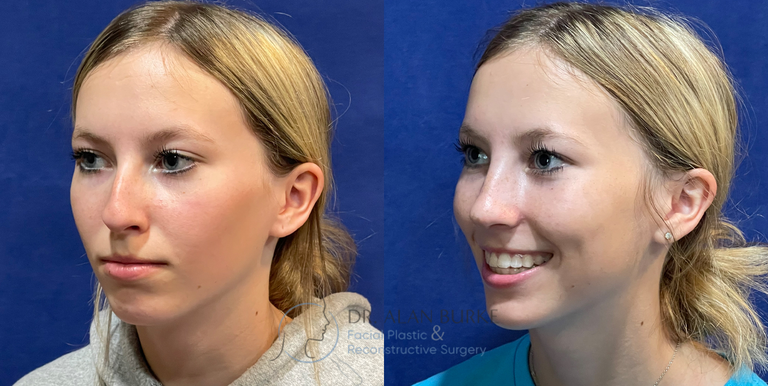Before and After Image: Rhinoplasty - left-front-oblique
