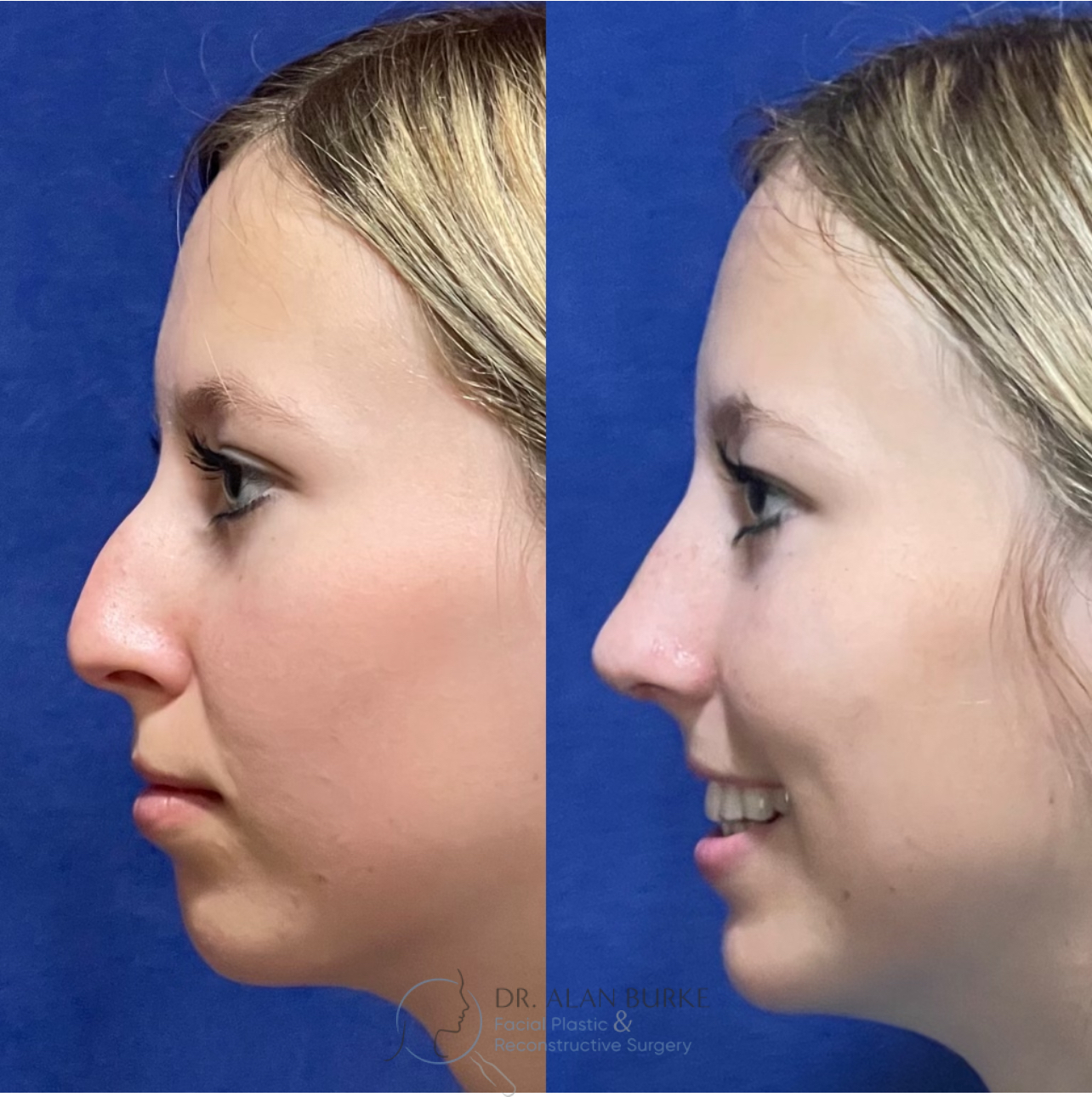 Before and After Image: Rhinoplasty - left-side