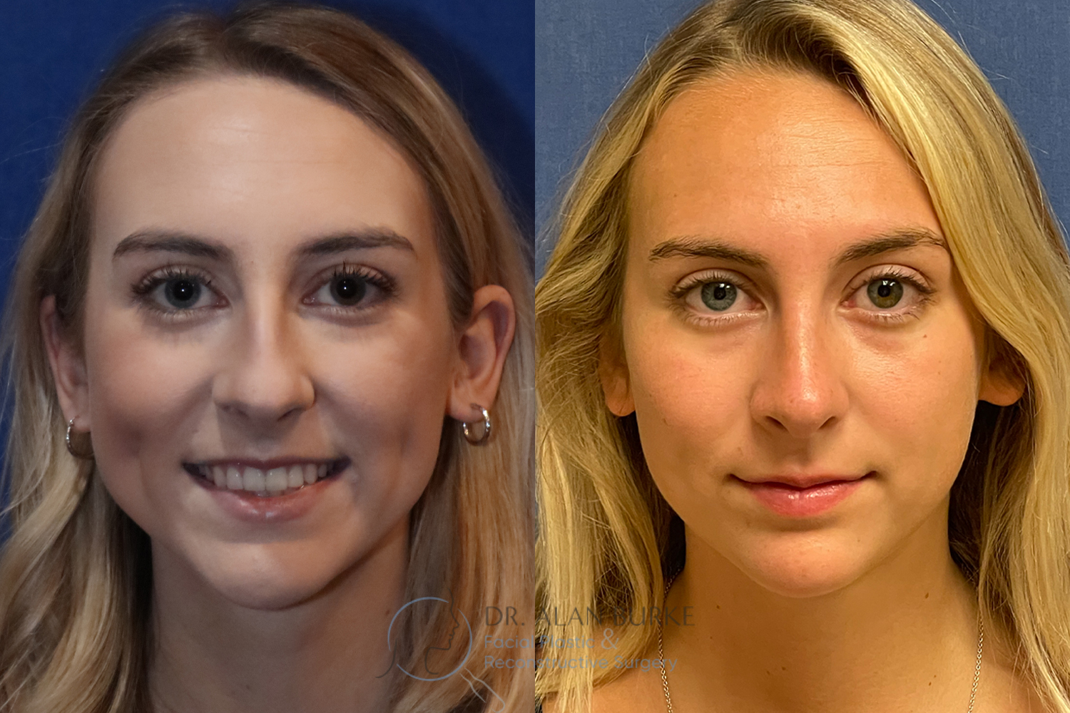 Before and After Image: Rhinoplasty - front