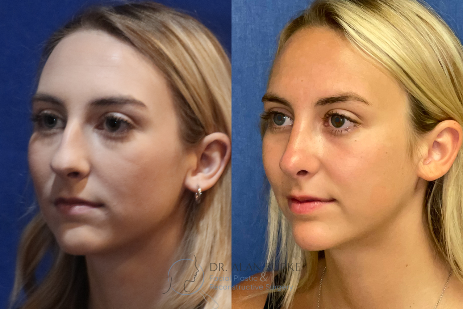 Before and After Image: Rhinoplasty - left-front-oblique