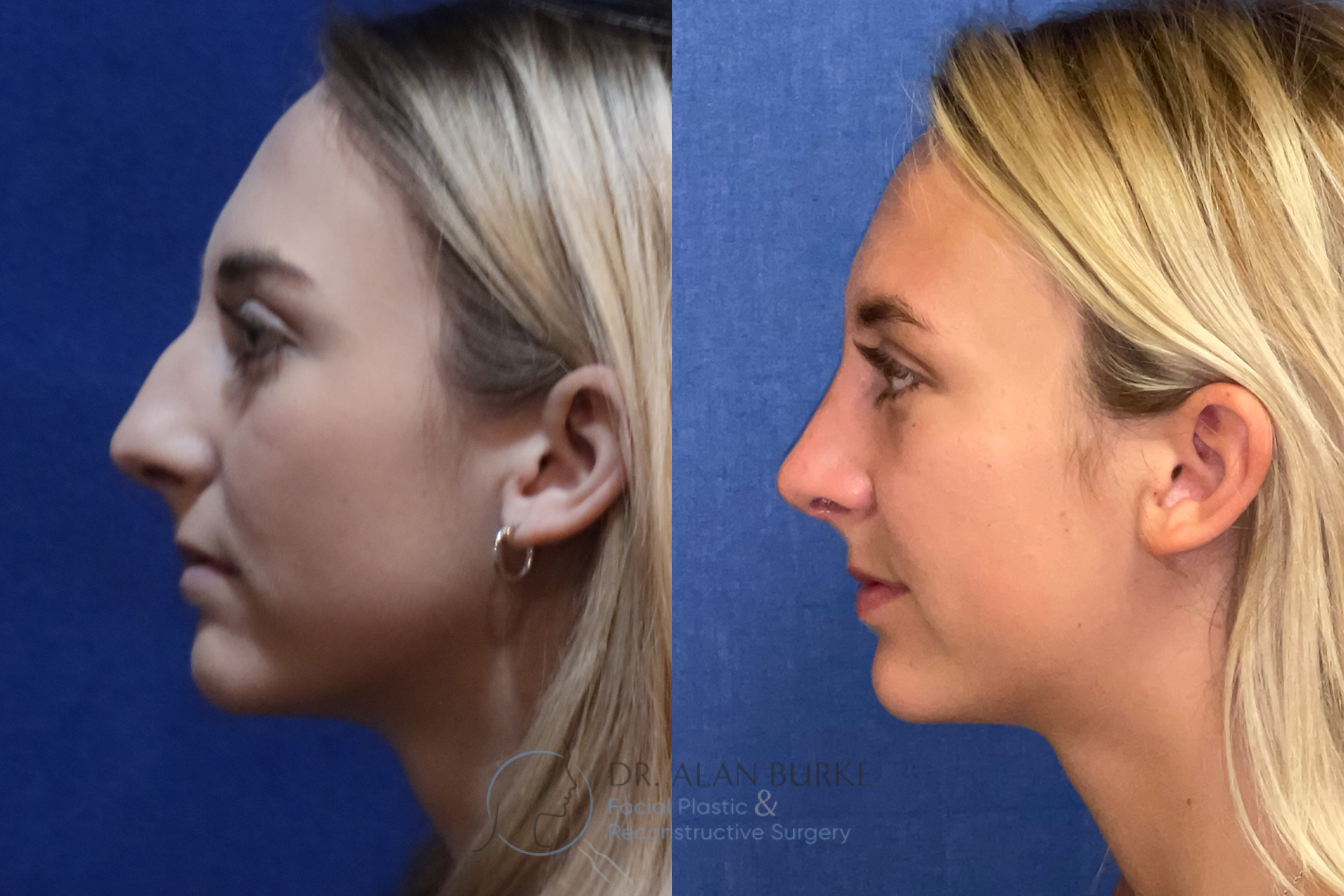 Before and After Image: Rhinoplasty - left-side