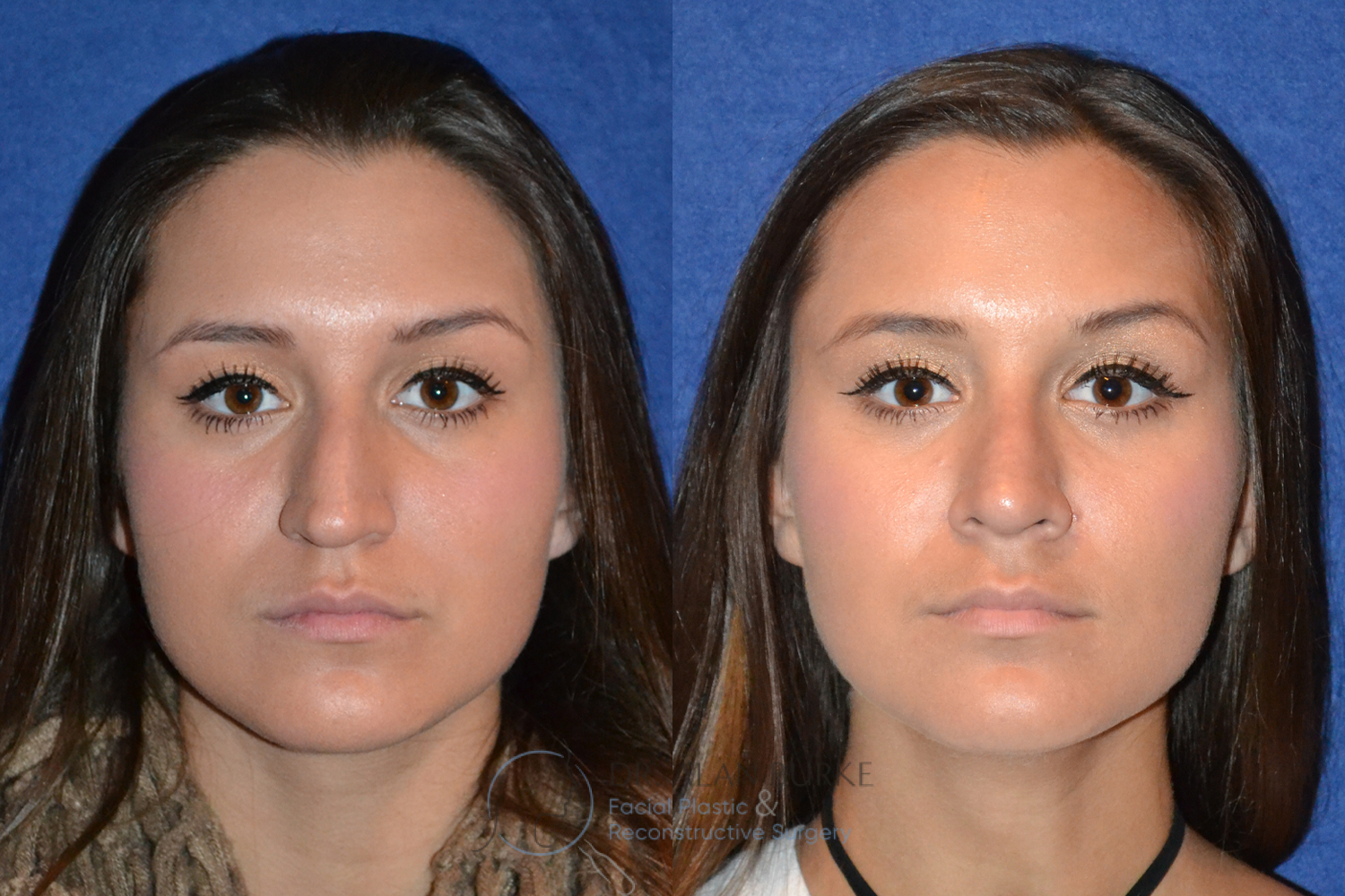 Before and After Image: Rhinoplasty - front
