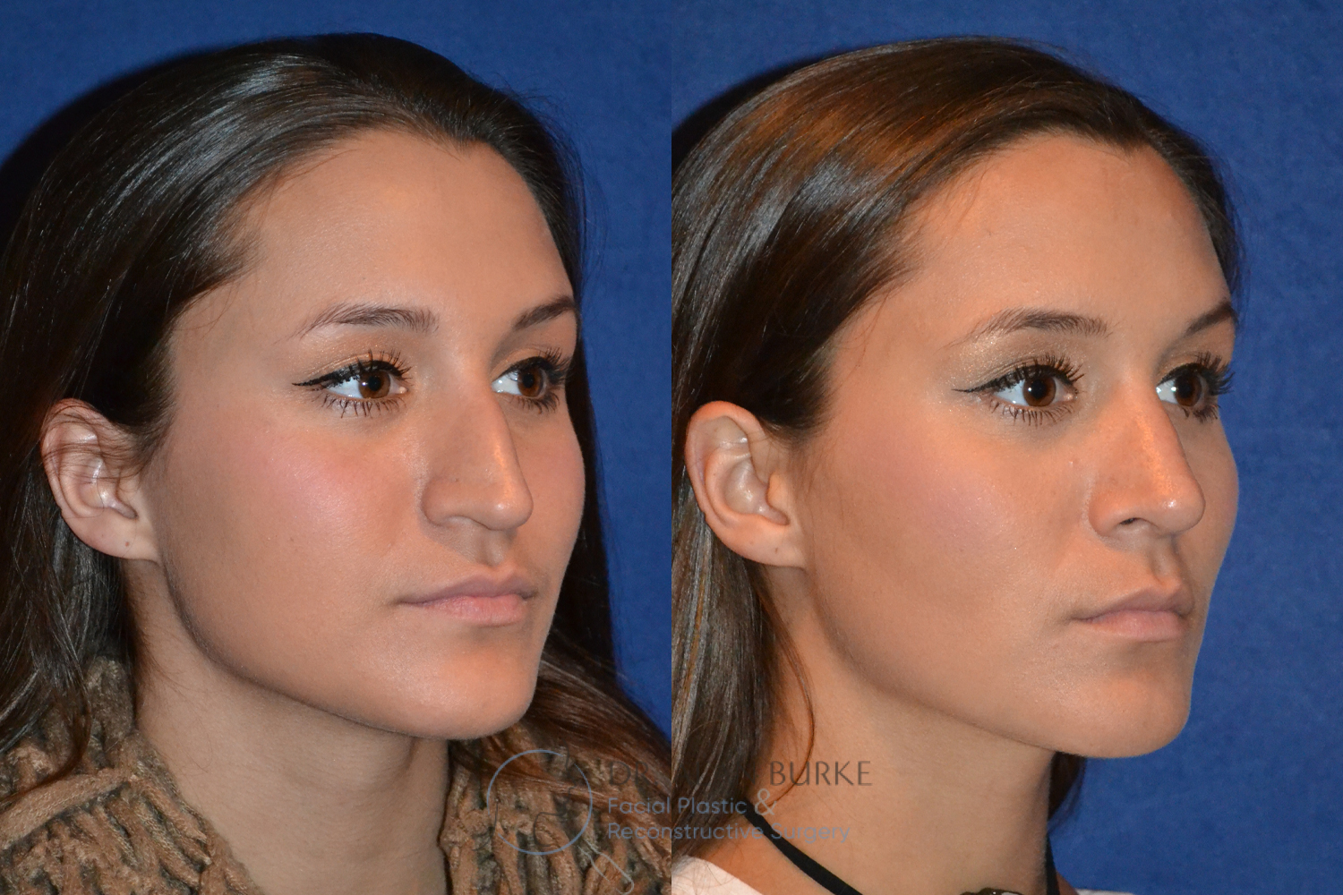 Before and After Image: Rhinoplasty - right-front-oblique