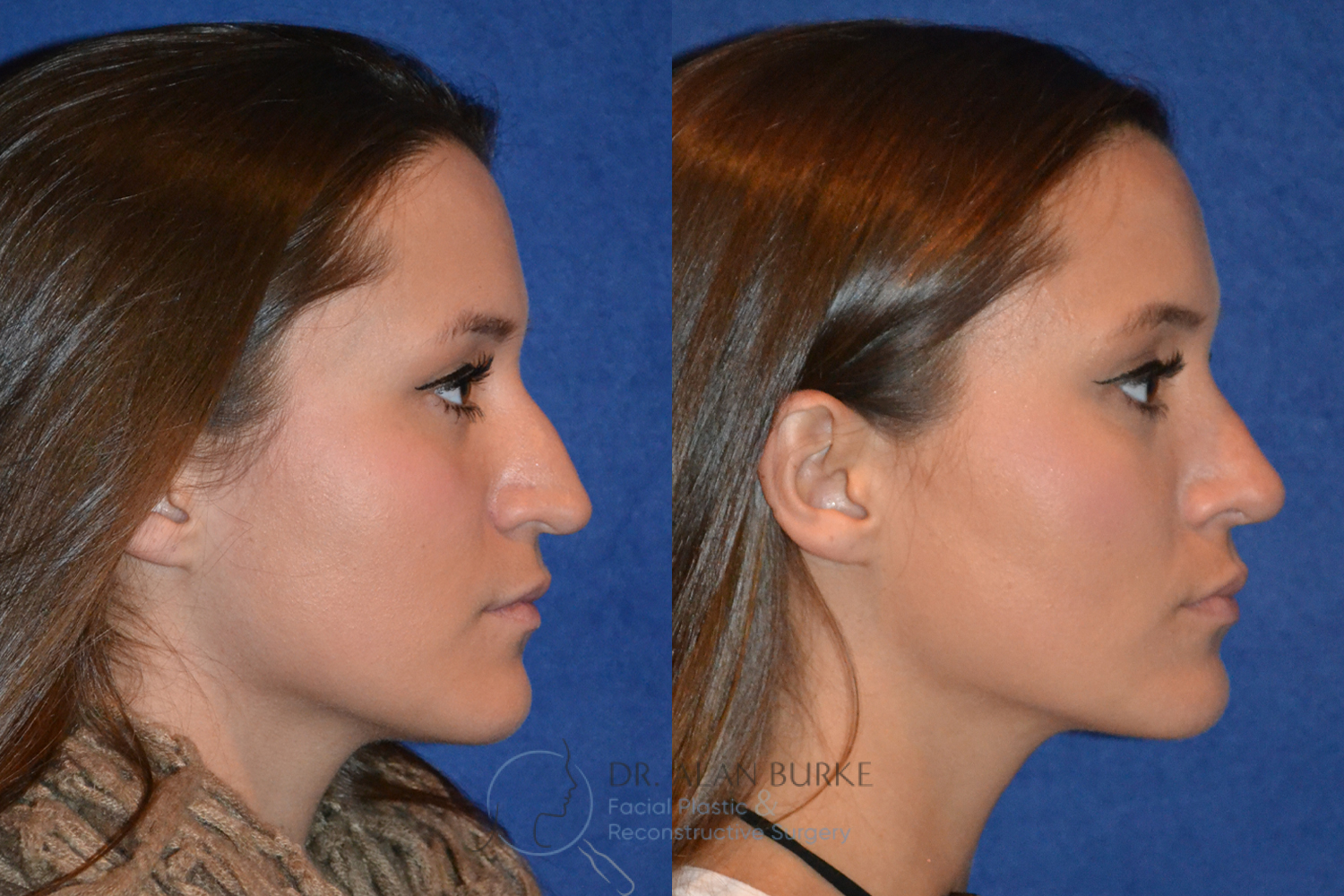 Before and After Image: Rhinoplasty - right-side