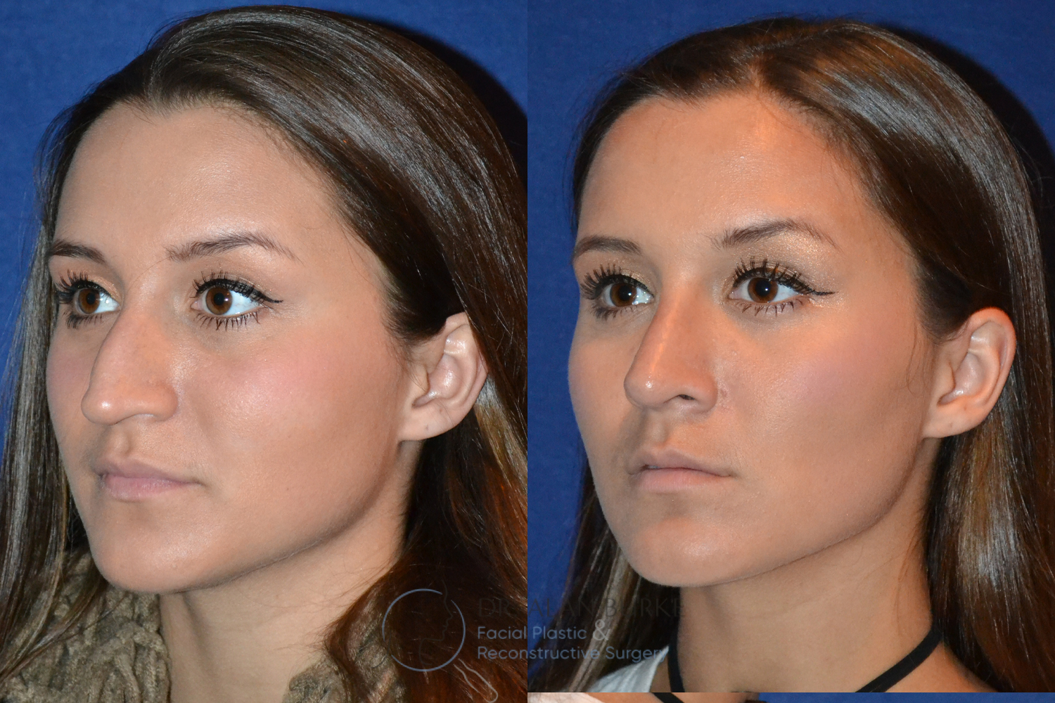 Before and After Image: Rhinoplasty - left-front-oblique