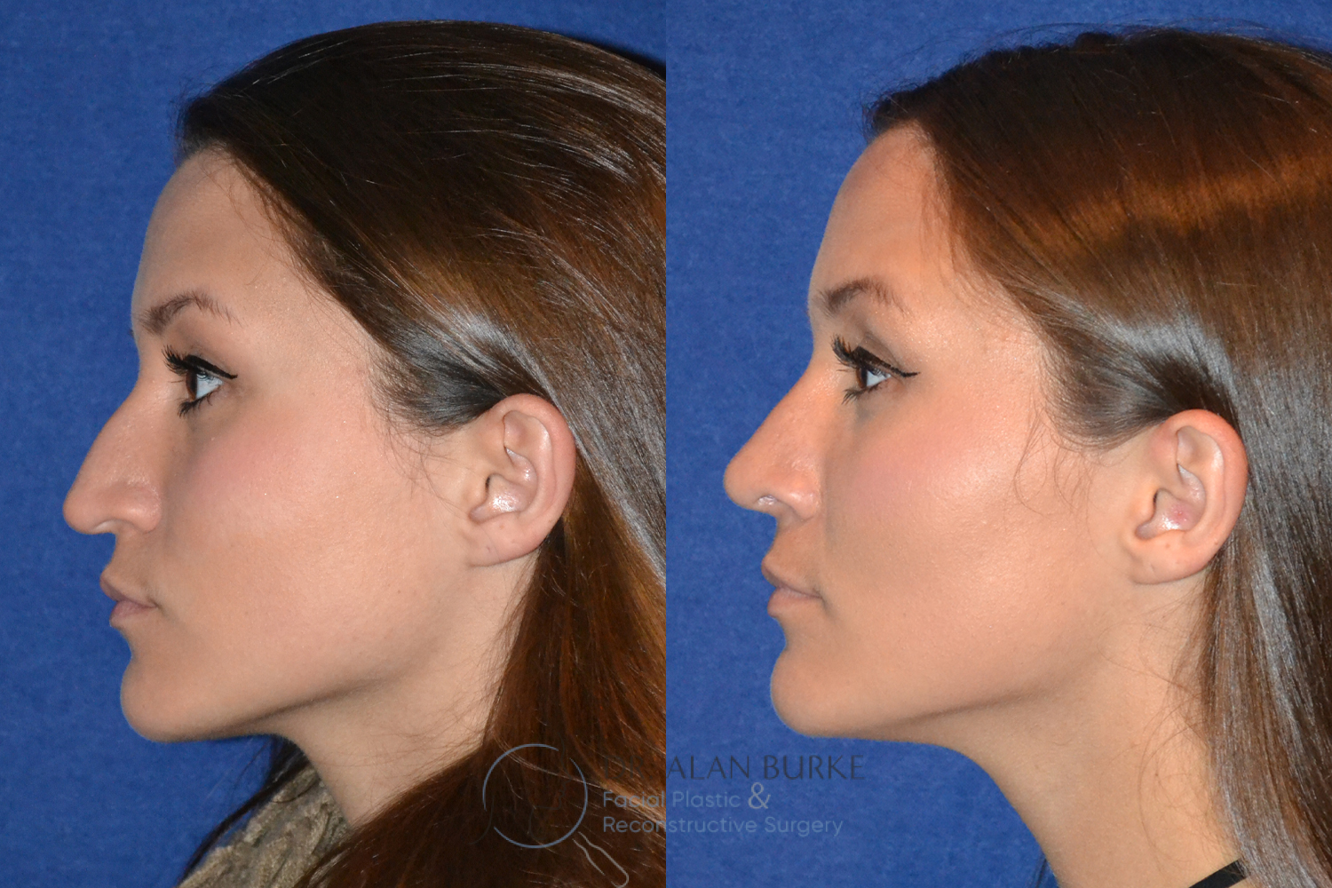 Before and After Image: Rhinoplasty - left-side