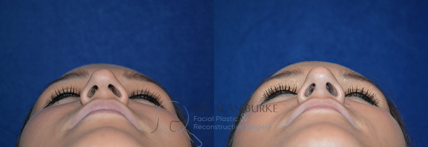 Before and After Image: Rhinoplasty - front